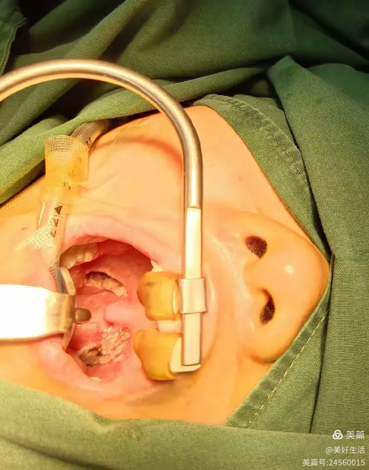 低温等离子扁桃体腺样体切除术:微创手术优势多!